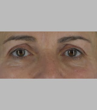 Upper Blepharoplasty Before & After Gallery - Patient 188833 - Image 2