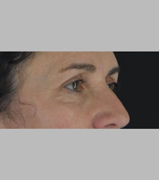 Upper Blepharoplasty Before & After Gallery - Patient 188833 - Image 4