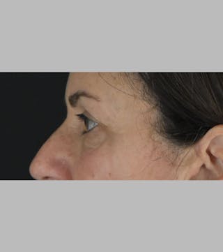 Upper Blepharoplasty Before & After Gallery - Patient 188833 - Image 6