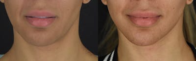 Neck Lift Before & After Gallery - Patient 375889 - Image 1