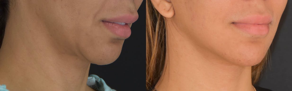Neck Lift Before & After Gallery - Patient 375889 - Image 2