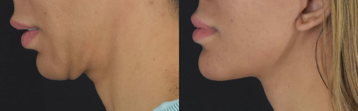 Neck Lift Before & After Gallery - Patient 375889 - Image 5