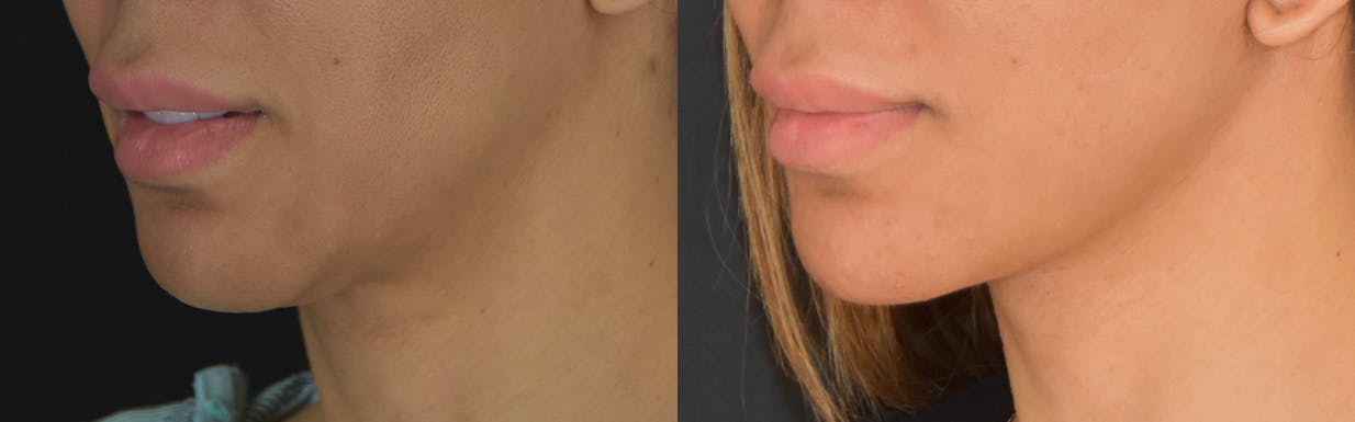 Neck Lift Before & After Gallery - Patient 375889 - Image 4