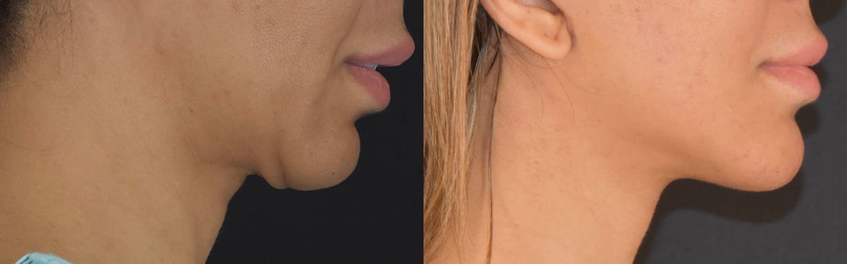 Neck Lift Before & After Gallery - Patient 375889 - Image 3