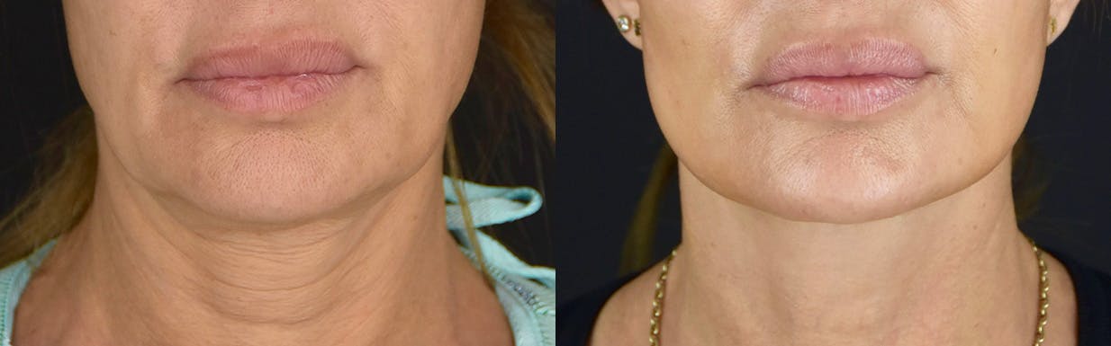 Neck Lift Before & After Gallery - Patient 360585 - Image 1