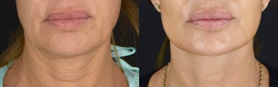 Neck Lift Before & After Gallery - Patient 360585 - Image 1
