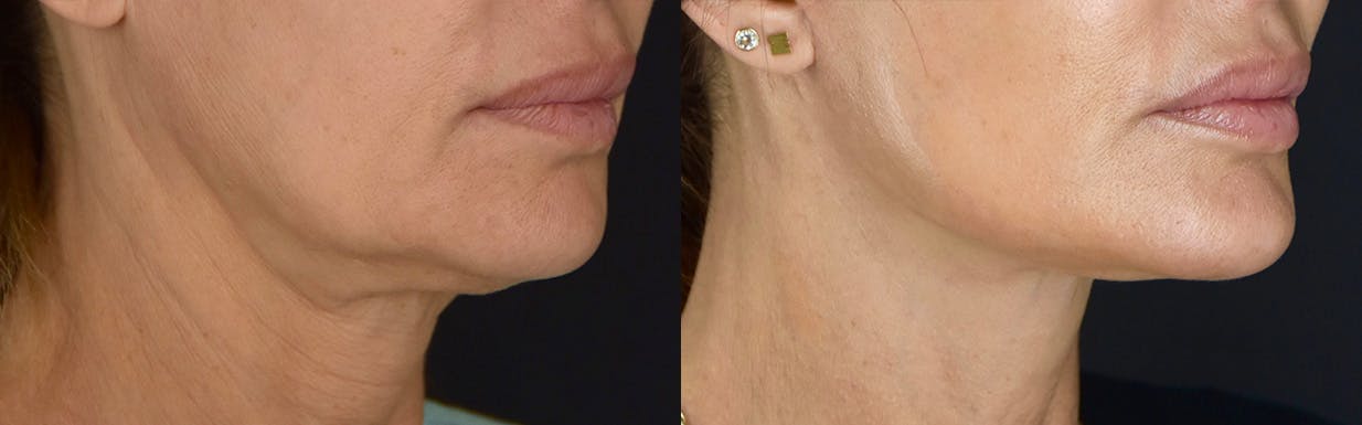 Neck Lift Before & After Gallery - Patient 360585 - Image 2