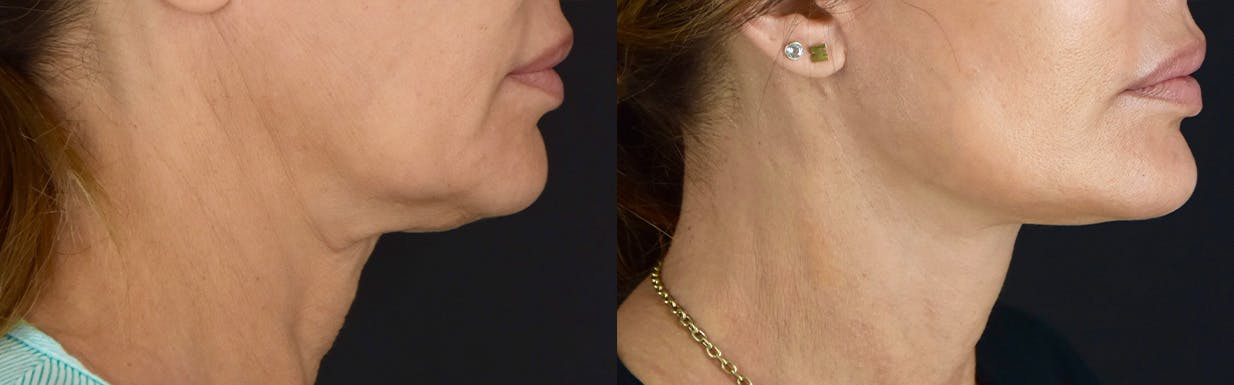 Neck Lift Before & After Gallery - Patient 360585 - Image 3