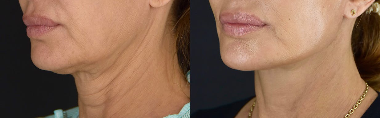 Neck Lift Before & After Gallery - Patient 360585 - Image 4