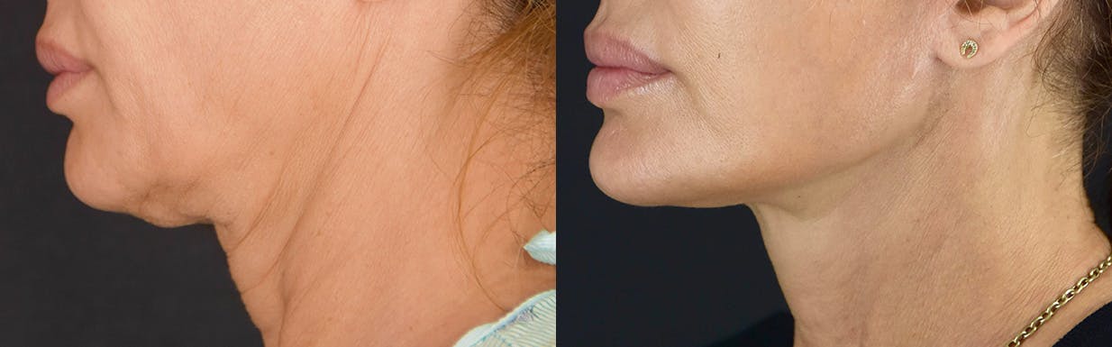 Neck Lift Before & After Gallery - Patient 360585 - Image 5