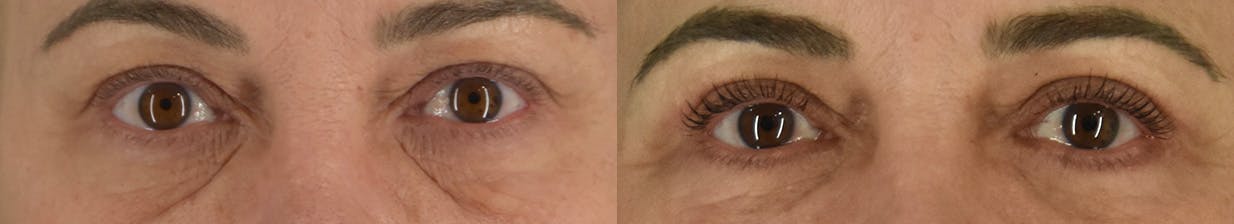 Upper Blepharoplasty Before & After Gallery - Patient 417752 - Image 1