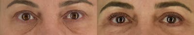 Upper Blepharoplasty Before & After Gallery - Patient 417752 - Image 1
