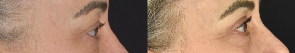 Upper Blepharoplasty Before & After Gallery - Patient 417752 - Image 3