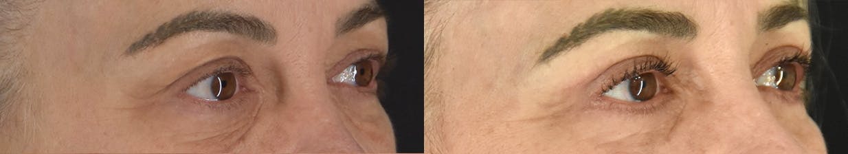 Upper Blepharoplasty Before & After Gallery - Patient 417752 - Image 2