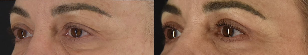 Upper Blepharoplasty Before & After Gallery - Patient 417752 - Image 4