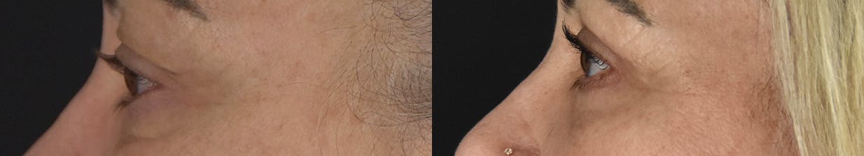 Upper Blepharoplasty Before & After Gallery - Patient 417752 - Image 5