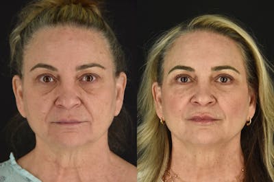C02 Laser Before & After Gallery - Patient 399835 - Image 1