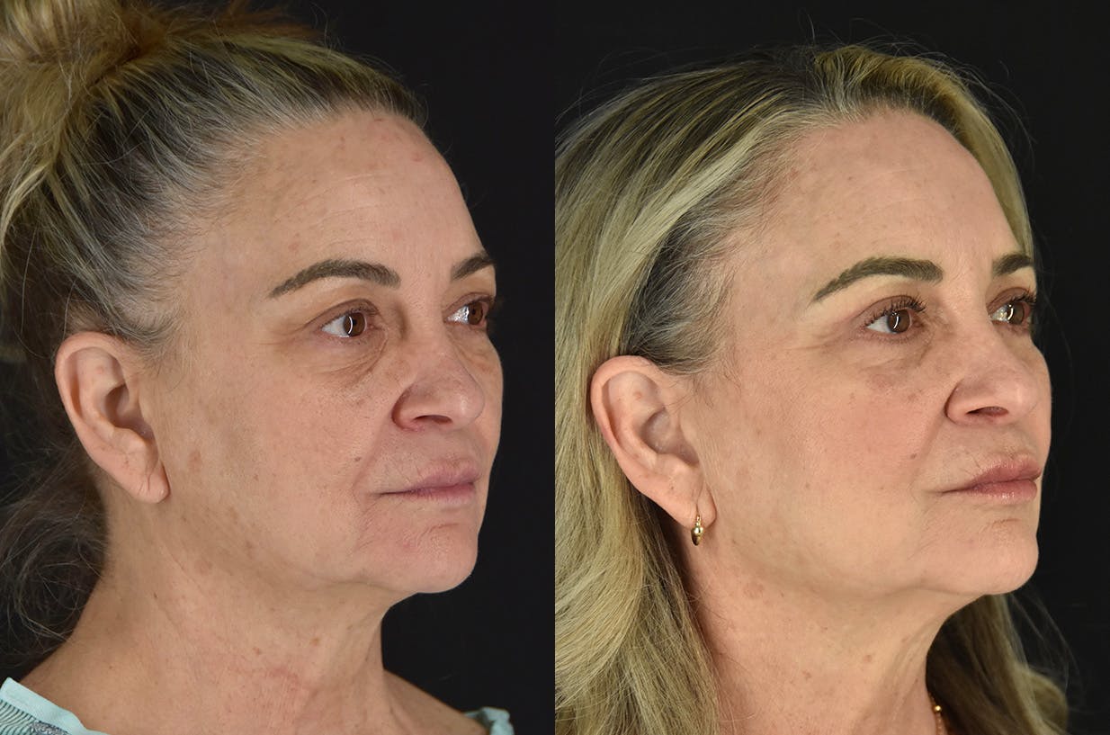 C02 Laser Before & After Gallery - Patient 399835 - Image 2