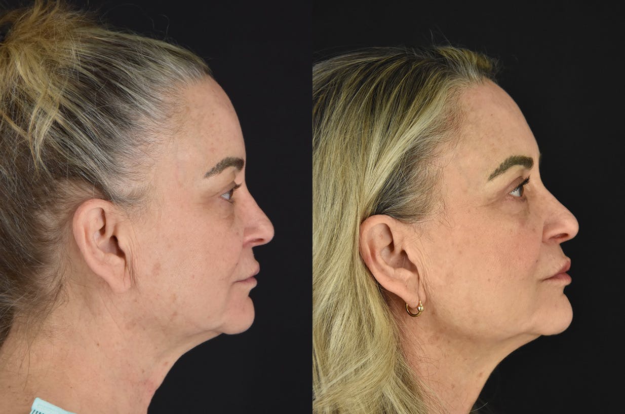C02 Laser Before & After Gallery - Patient 399835 - Image 3