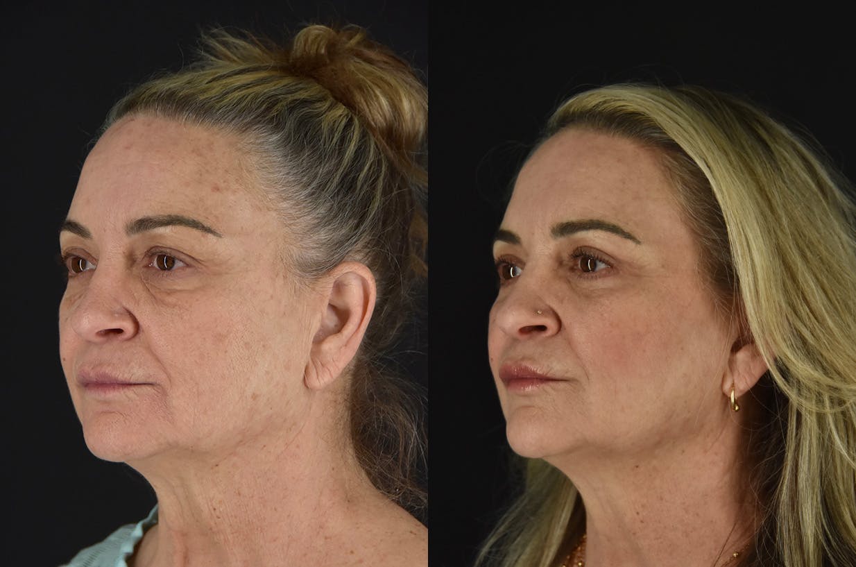C02 Laser Before & After Gallery - Patient 399835 - Image 4