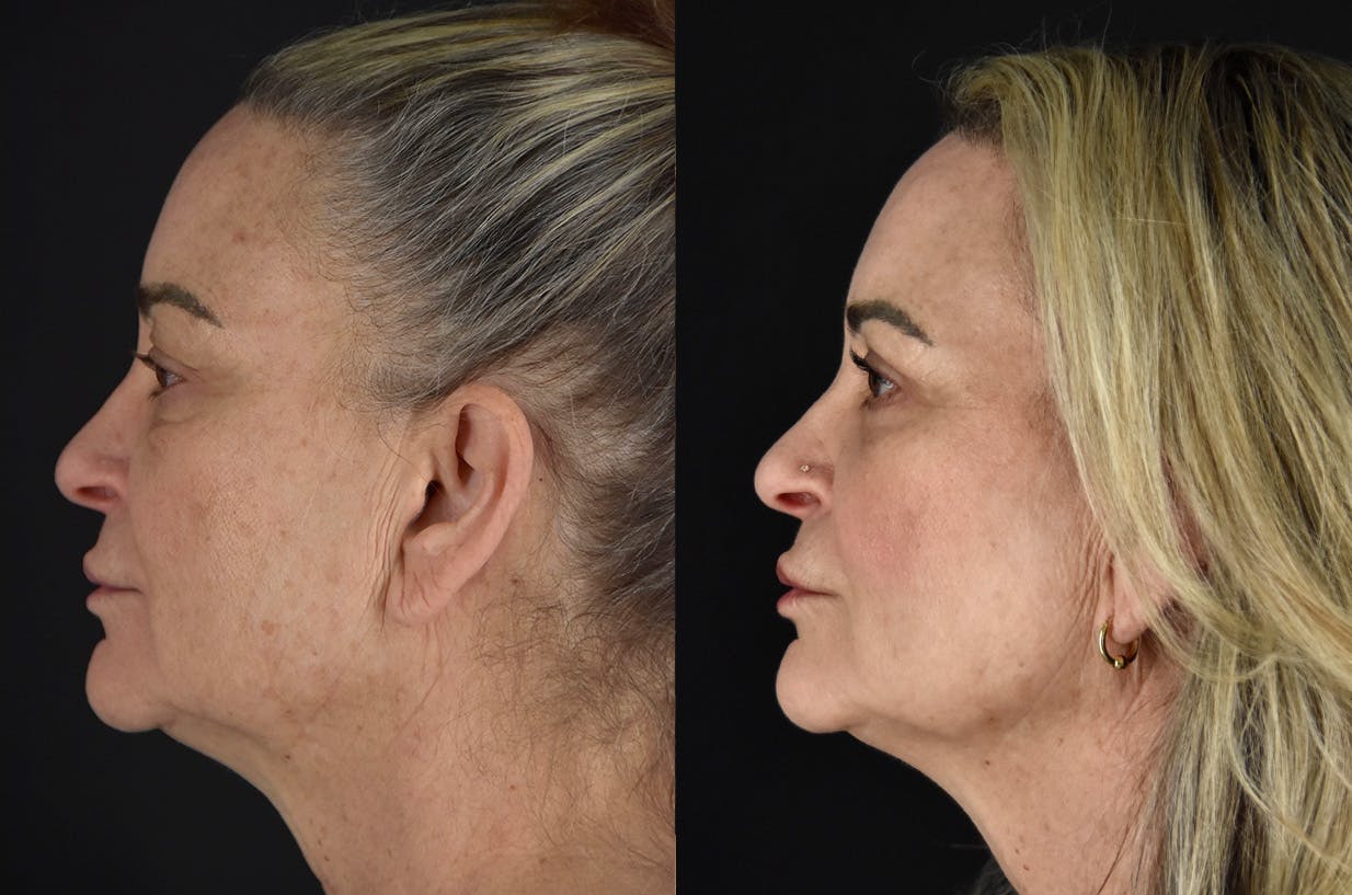 C02 Laser Before & After Gallery - Patient 399835 - Image 5