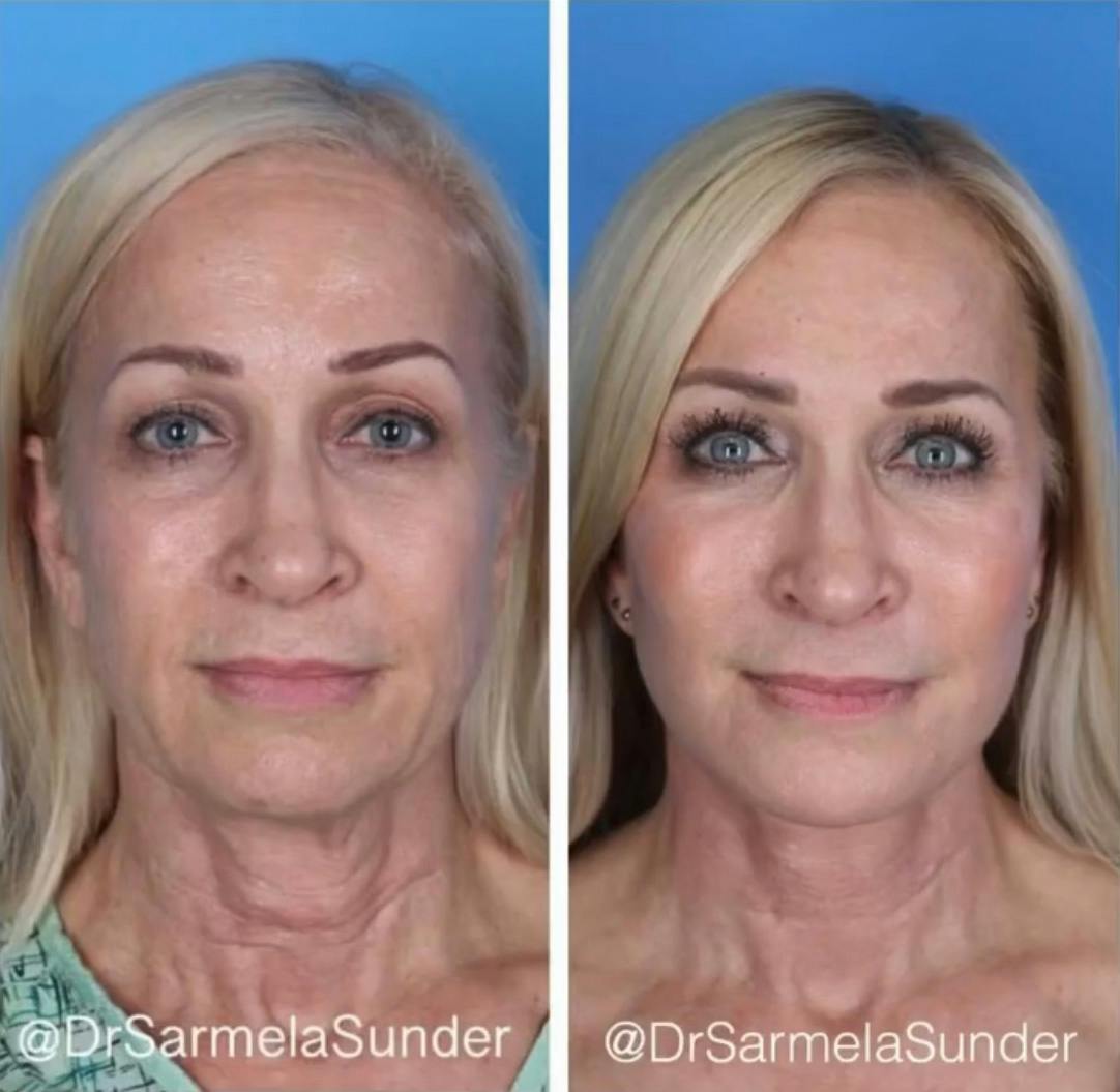Before & After Facelift
