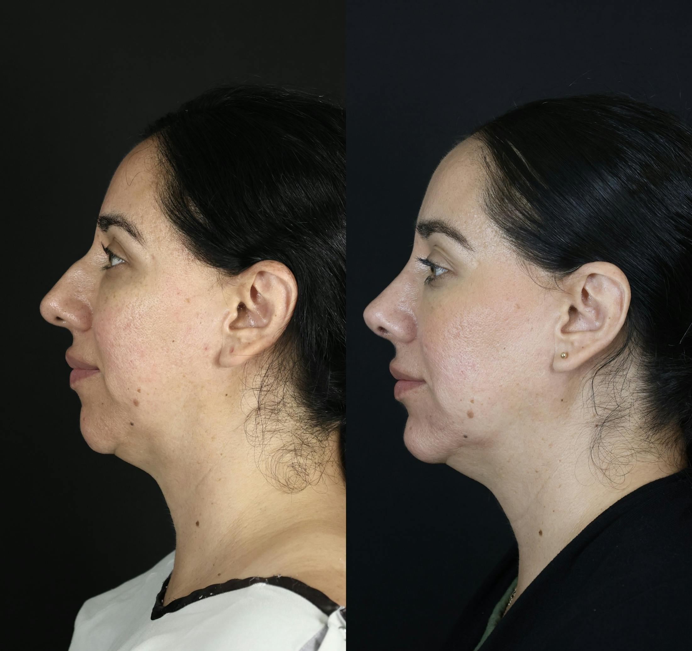 Rhinoplasty Before & After Gallery - Patient 407191 - Image 3