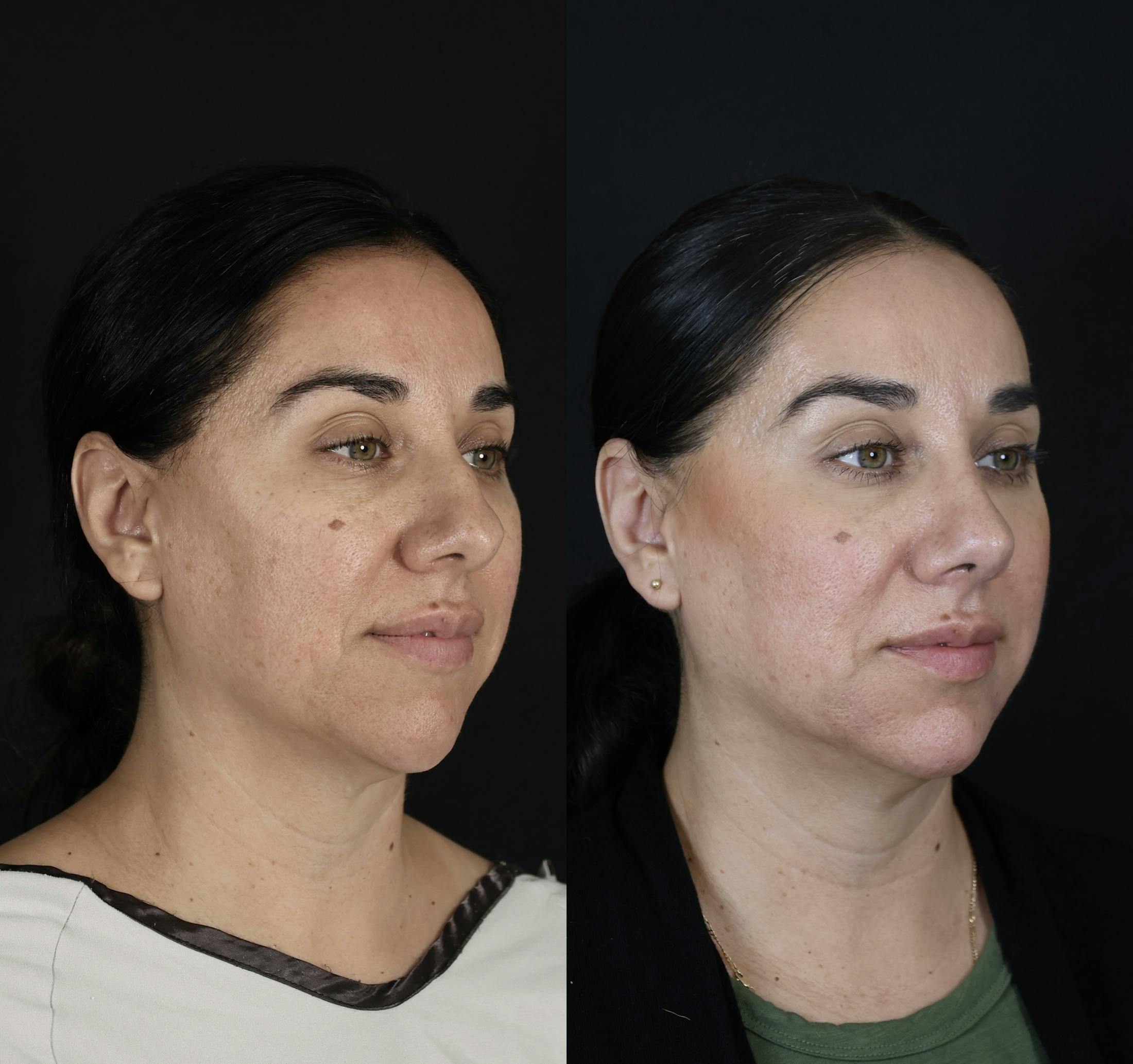 Rhinoplasty Before & After Gallery - Patient 407191 - Image 2