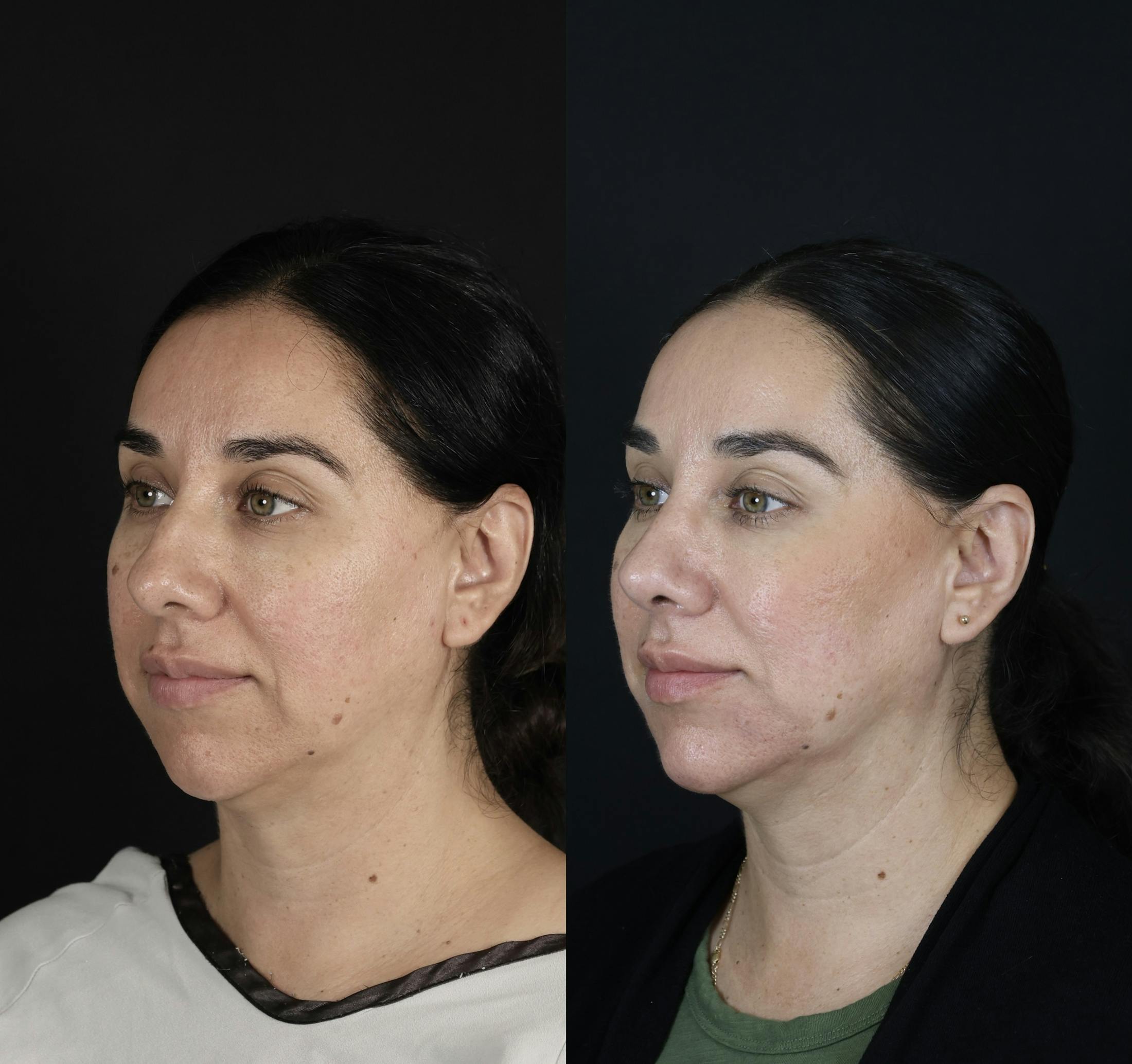 Rhinoplasty Before & After Gallery - Patient 407191 - Image 4