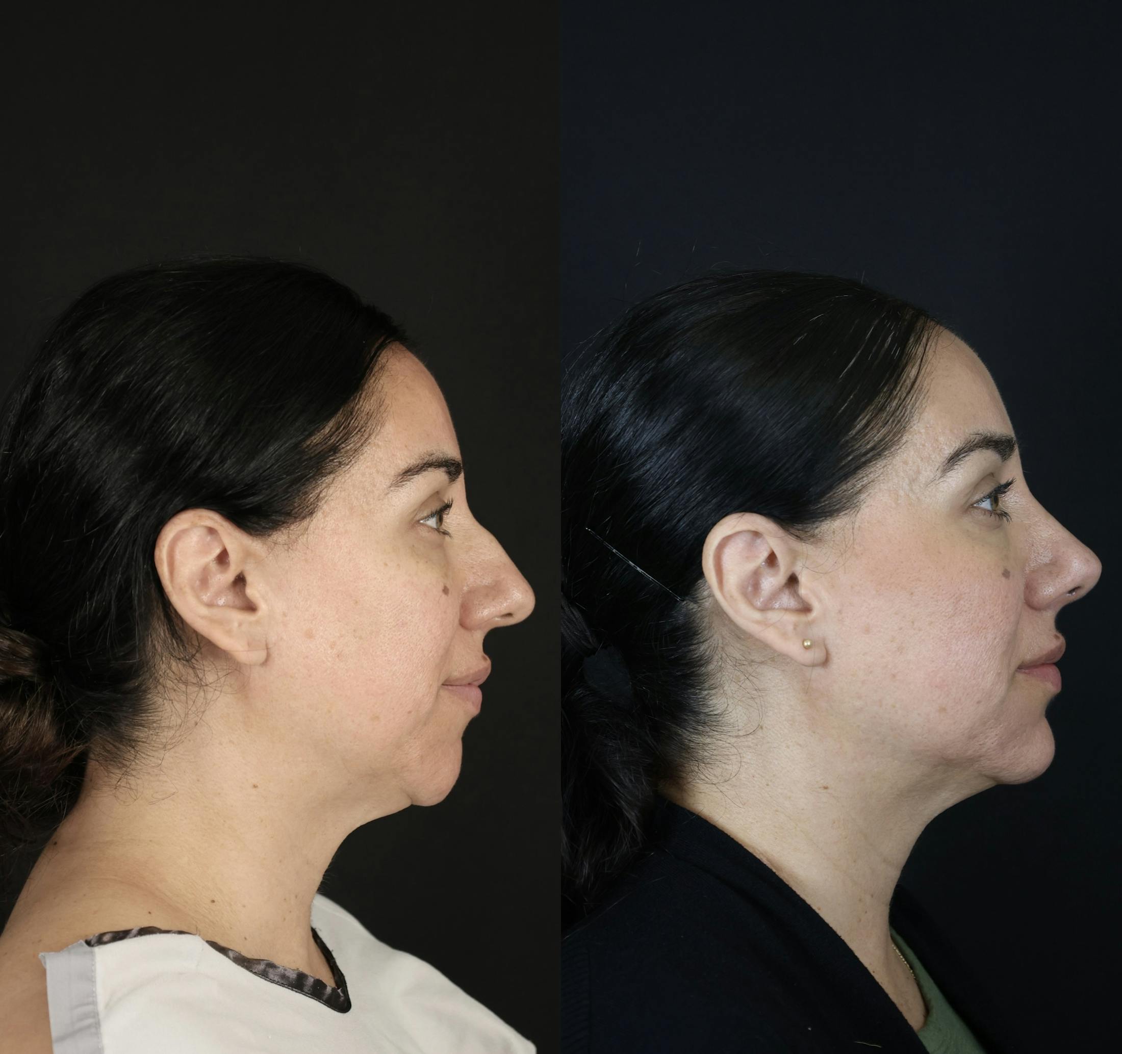 Rhinoplasty Before & After Gallery - Patient 407191 - Image 5