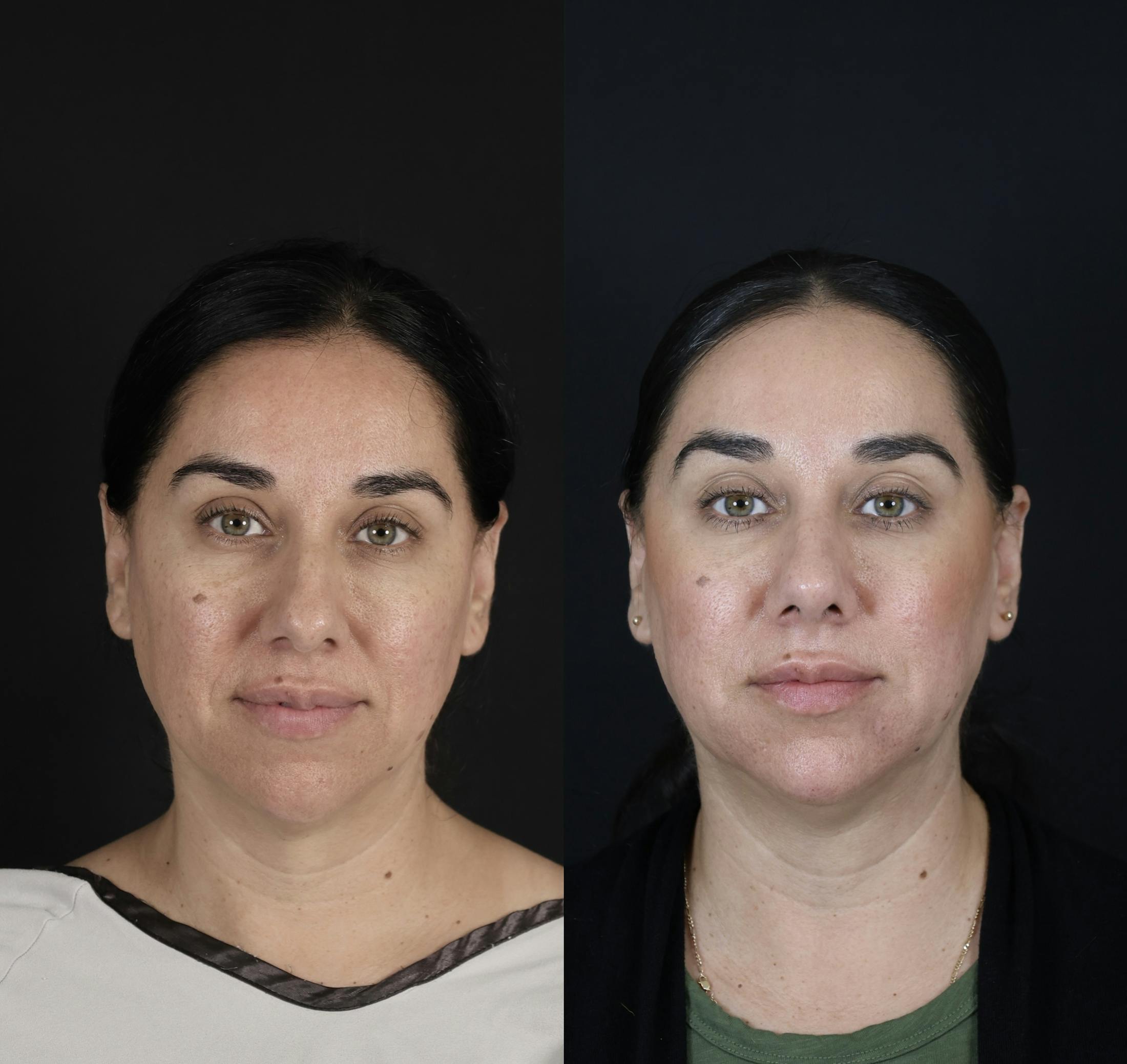 Rhinoplasty Before & After Gallery - Patient 407191 - Image 1