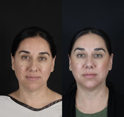 Rhinoplasty Before & After Gallery - Patient 407191 - Image 1