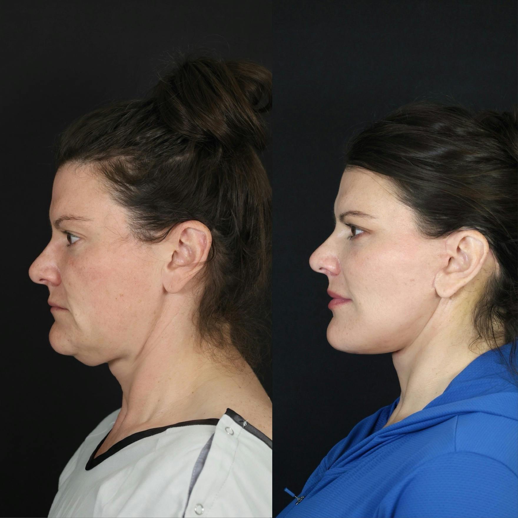 Neck Lift Before & After Gallery - Patient 391888 - Image 4