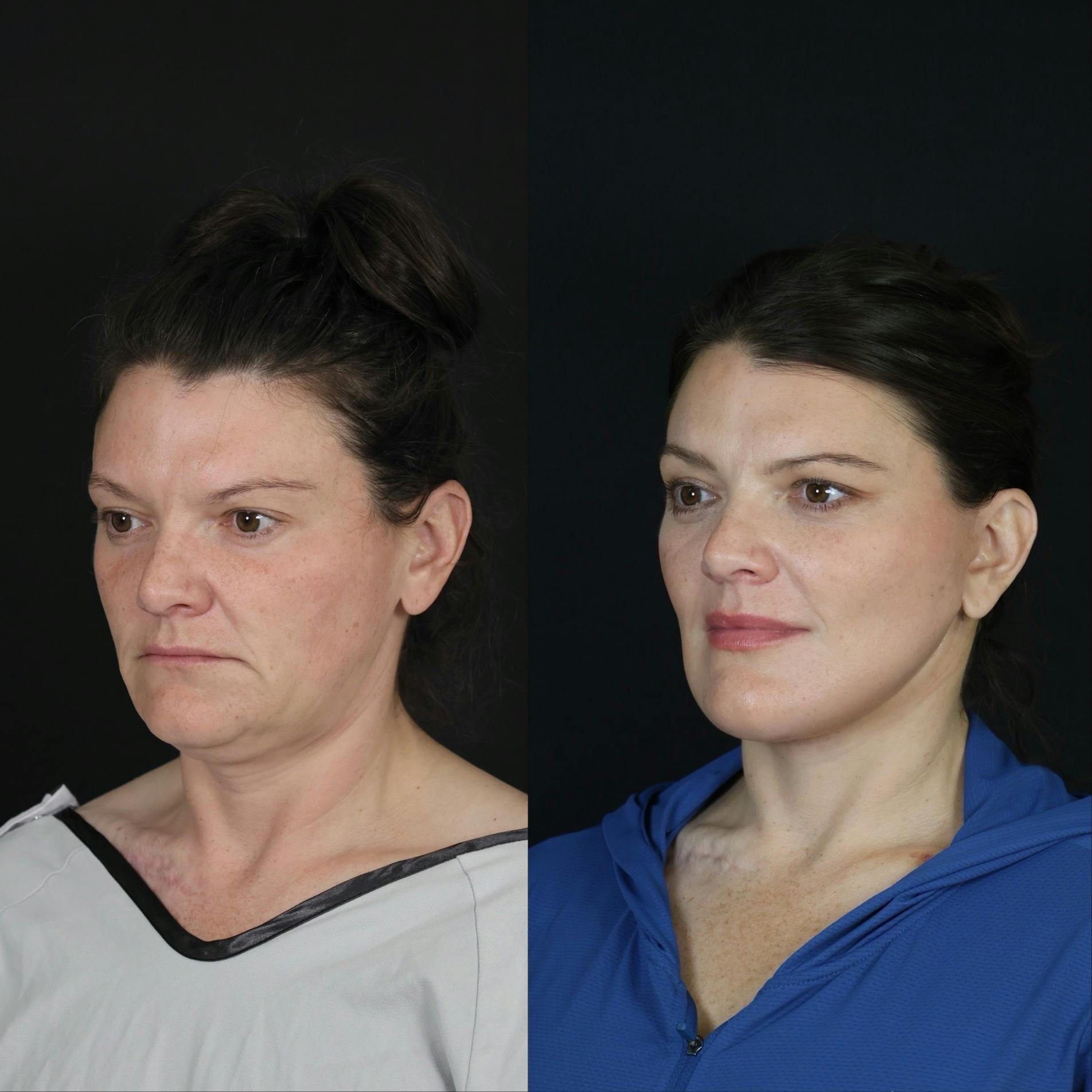Neck Lift Before & After Gallery - Patient 391888 - Image 5