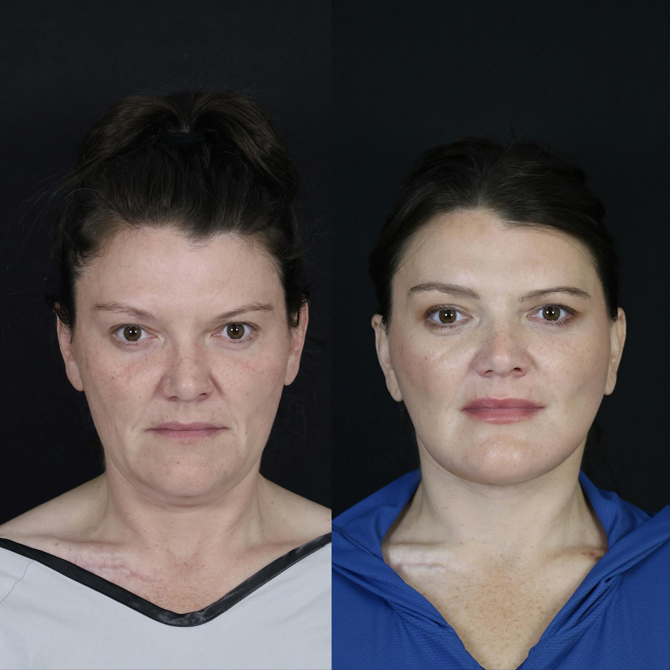 Neck Lift Before & After Gallery - Patient 391888 - Image 1