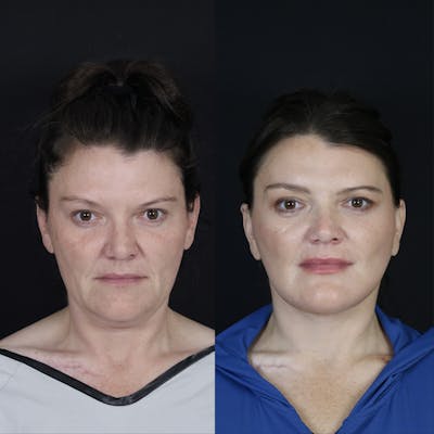 Neck Lift Before & After Gallery - Patient 391888 - Image 1