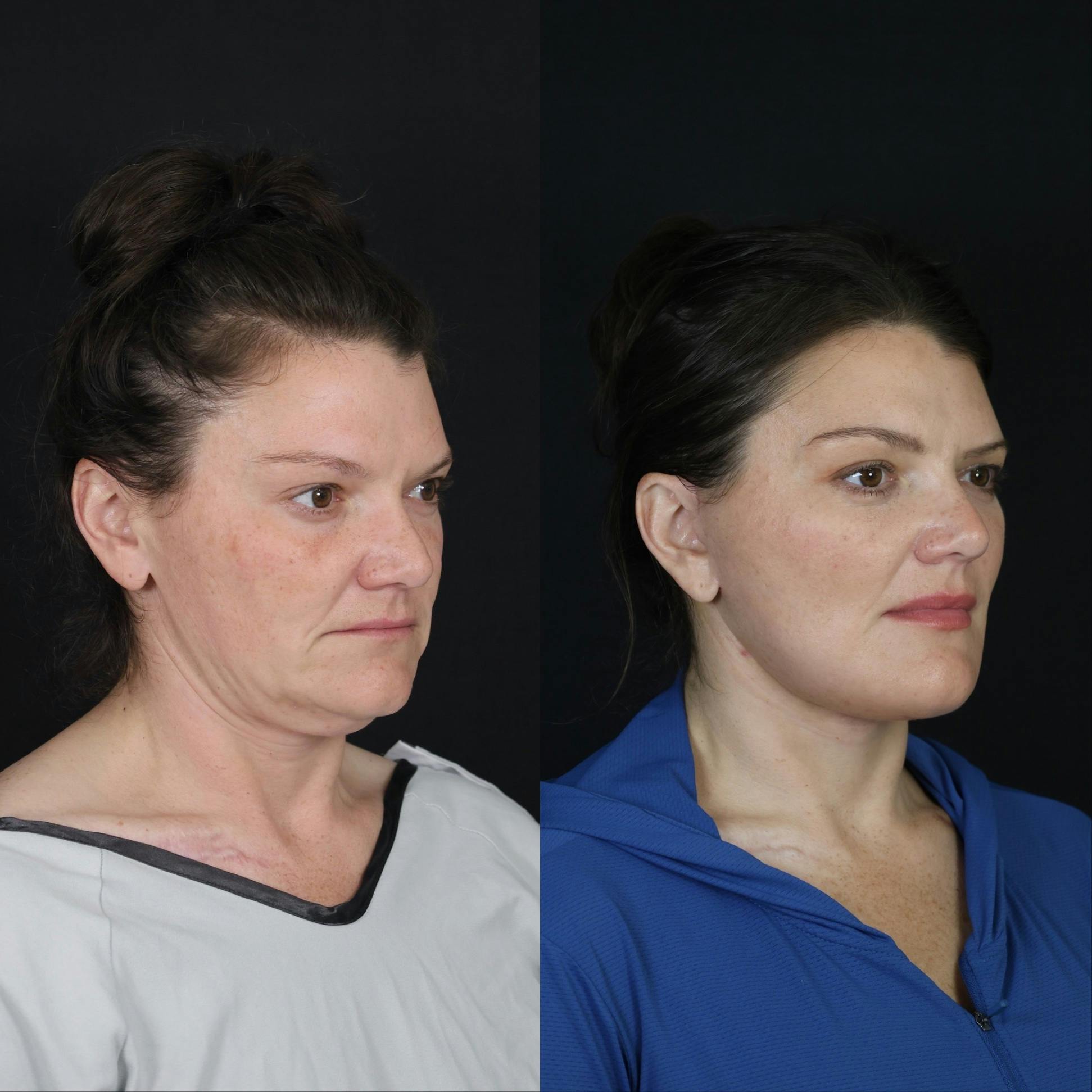 Neck Lift Before & After Gallery - Patient 391888 - Image 2