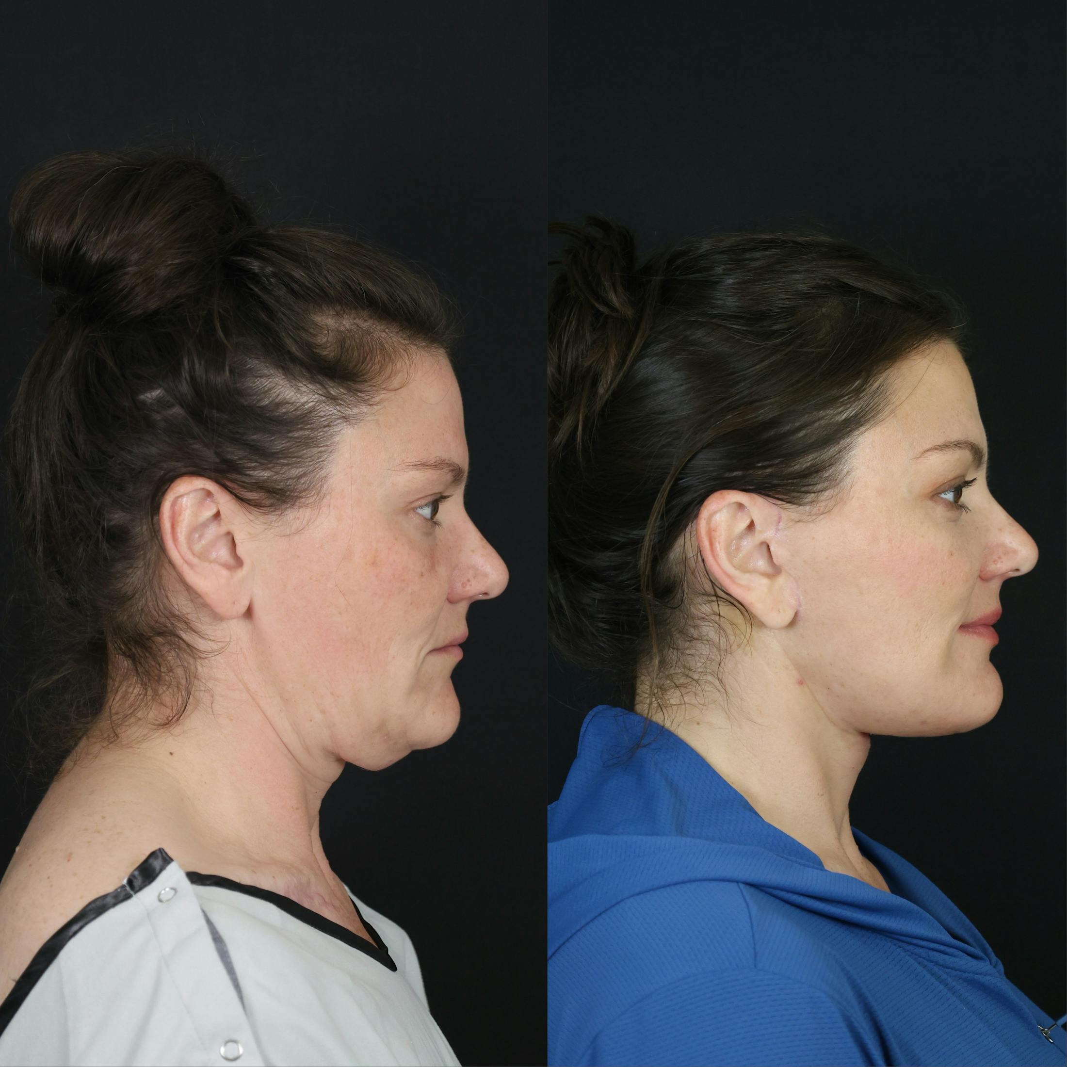 Neck Lift Before & After Gallery - Patient 391888 - Image 3