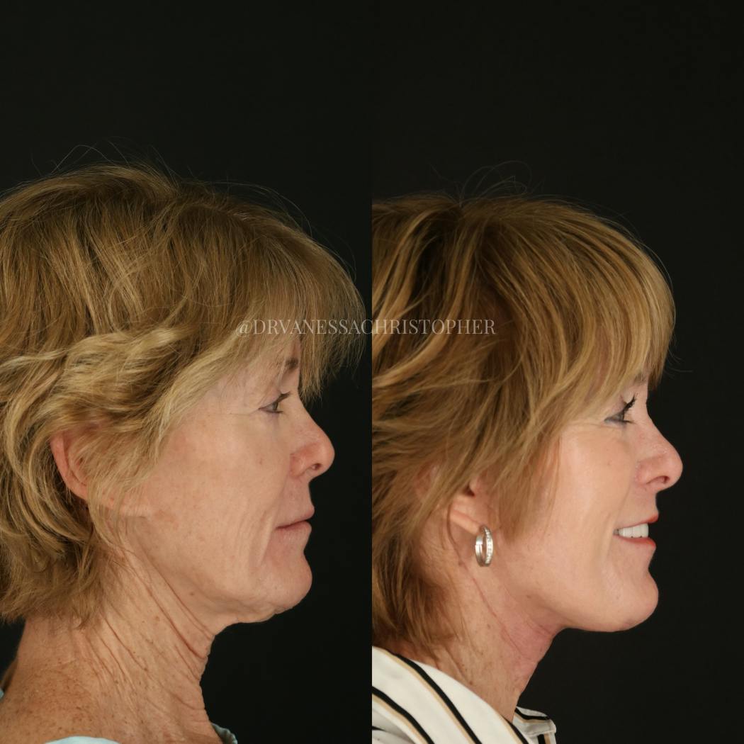 Neck Lift Before & After Gallery - Patient 327043 - Image 3