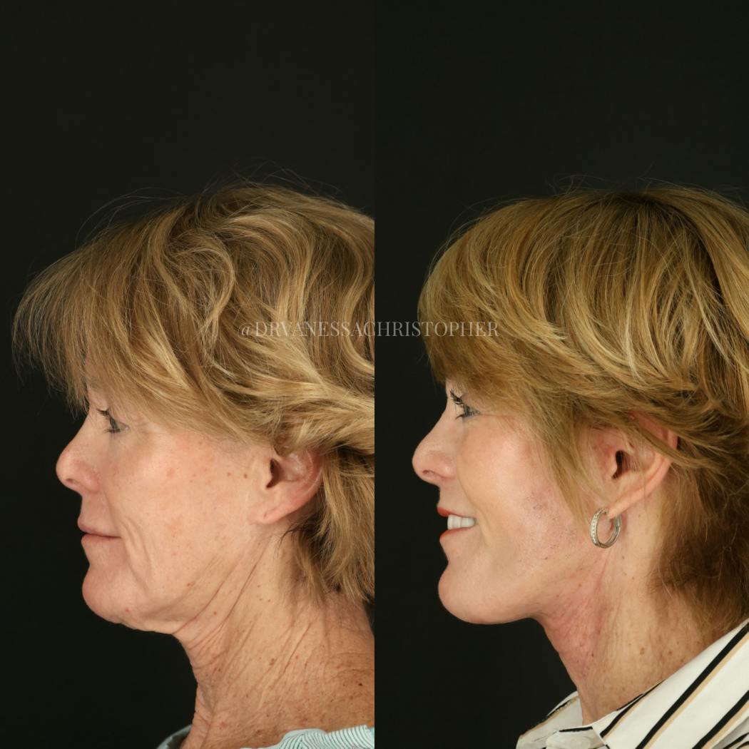 Neck Lift Before & After Gallery - Patient 327043 - Image 5
