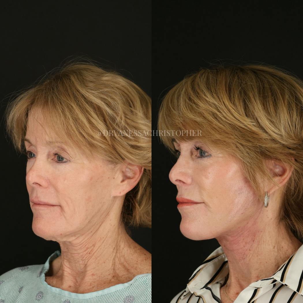 Neck Lift Before & After Gallery - Patient 327043 - Image 4