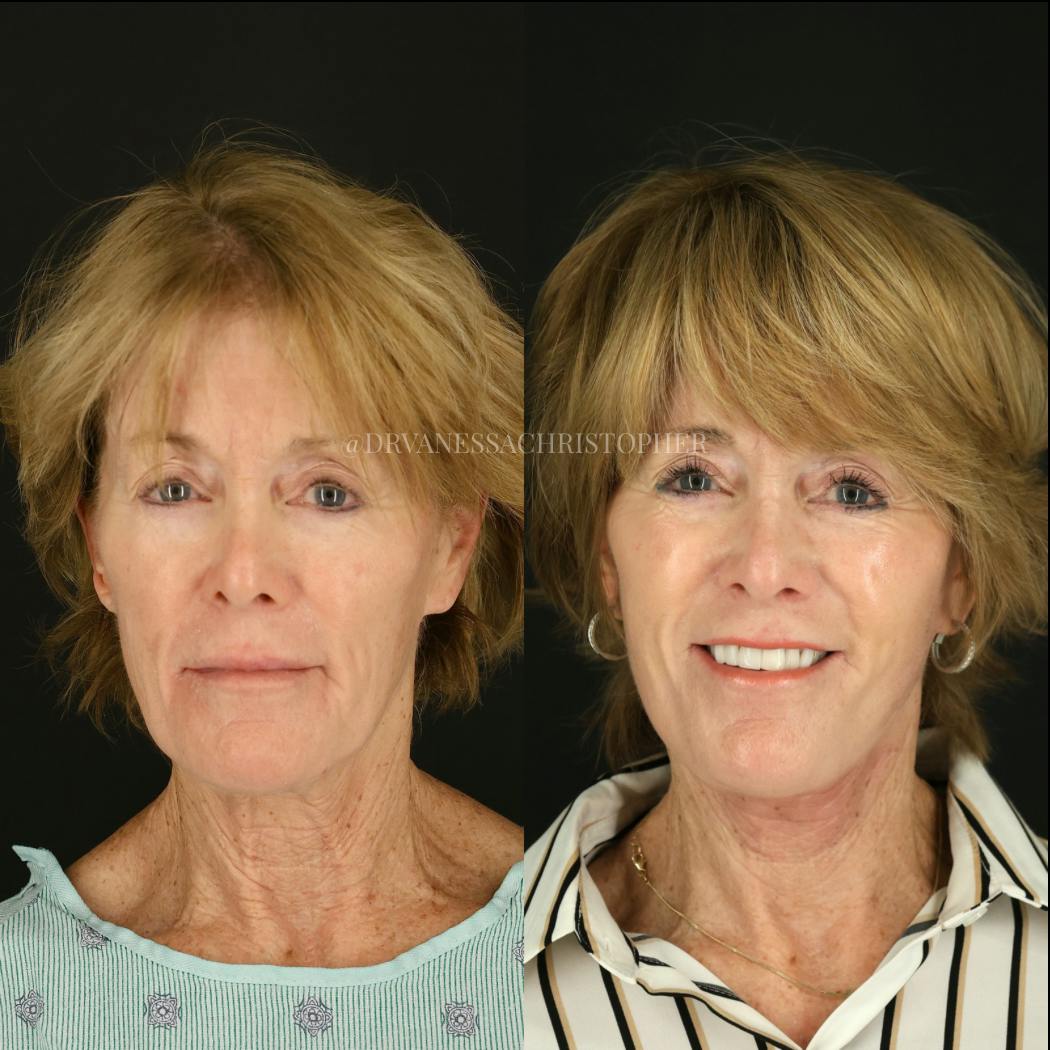 Neck Lift Before & After Gallery - Patient 327043 - Image 1