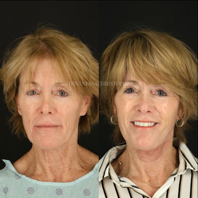 Neck Lift Before & After Gallery - Patient 327043 - Image 1