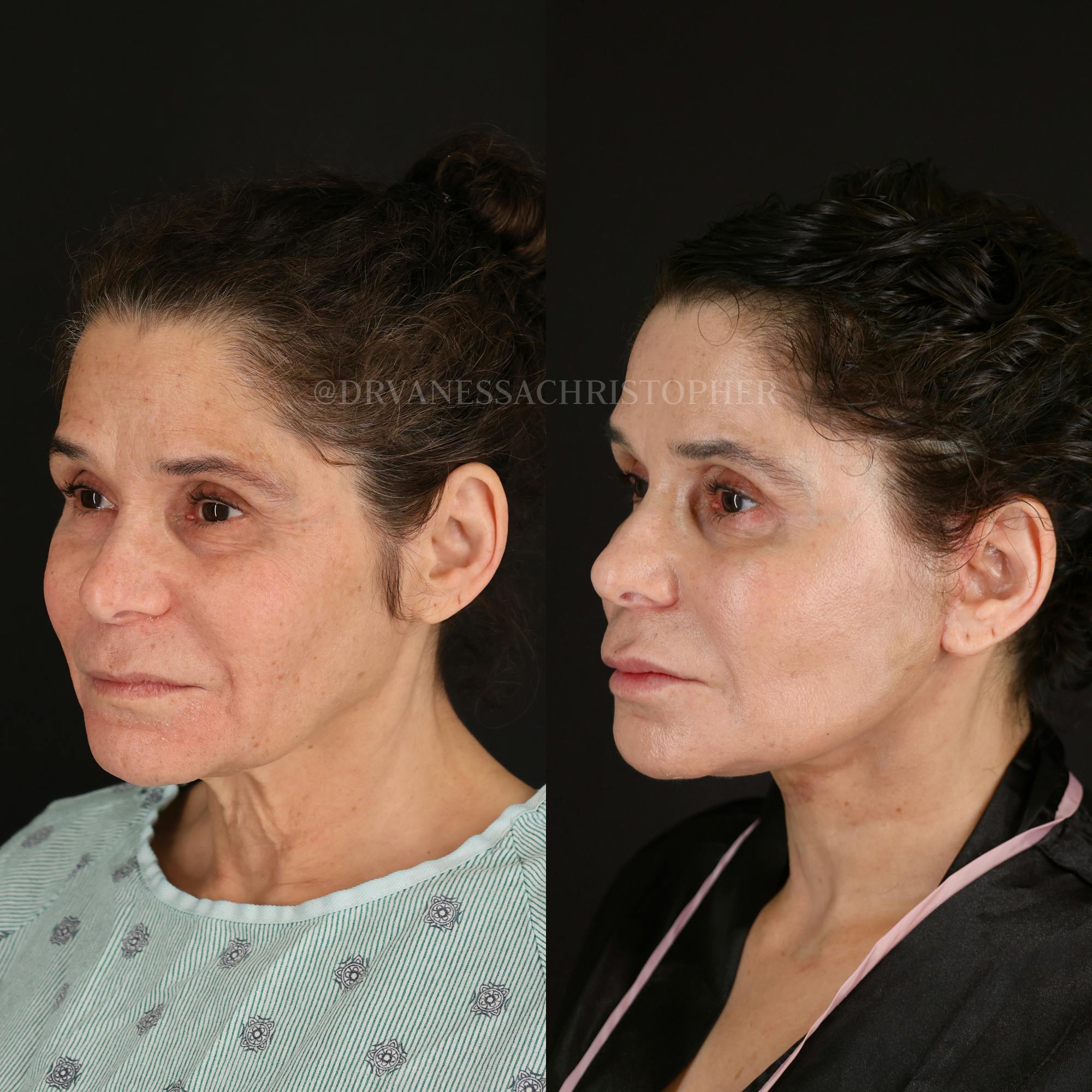 Neck Lift Before & After Gallery - Patient 165019 - Image 4