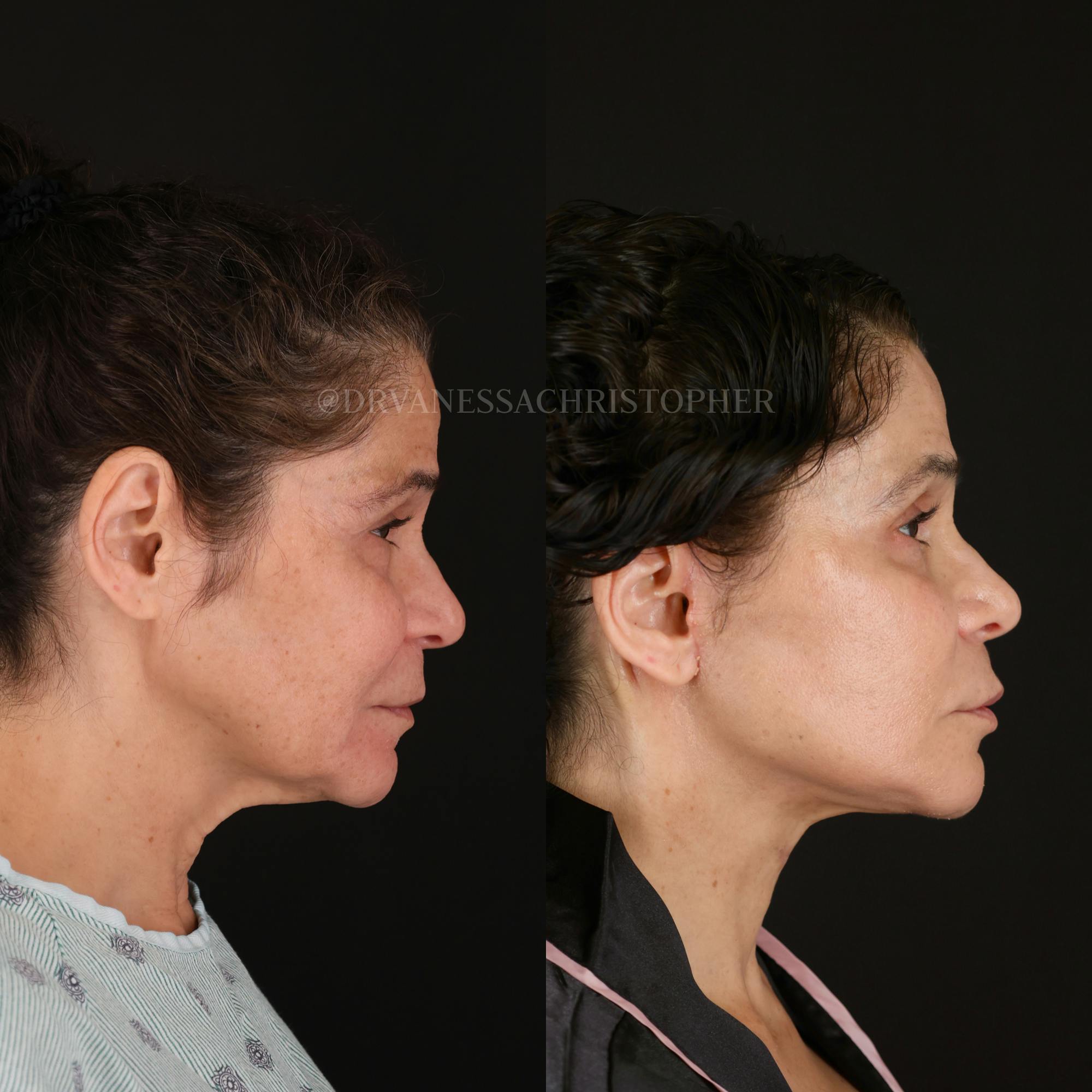 Neck Lift Before & After Gallery - Patient 165019 - Image 3