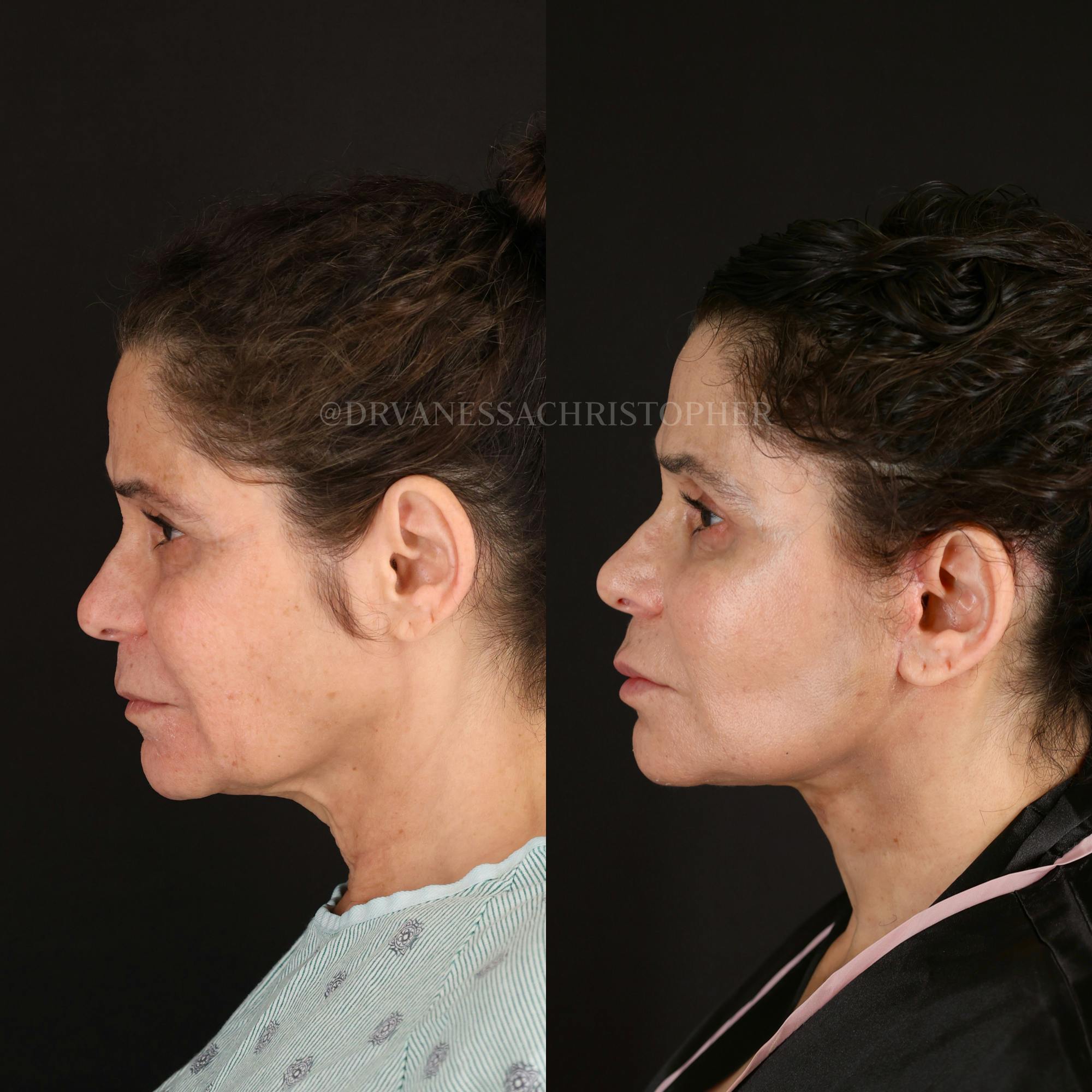 Neck Lift Before & After Gallery - Patient 165019 - Image 5