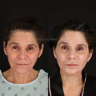 Neck Lift Before & After Gallery - Patient 165019 - Image 1