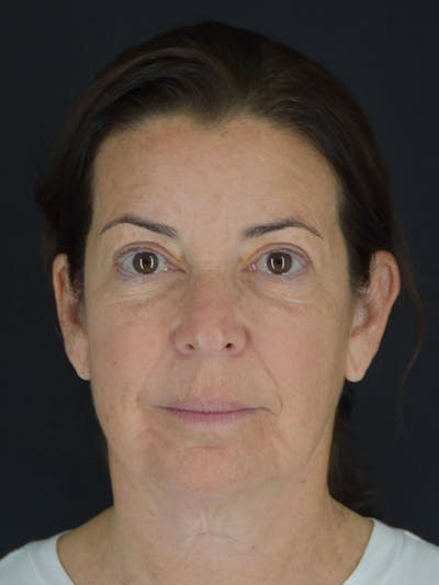 Fat Transfer Before & After Gallery - Patient 933449 - Image 1