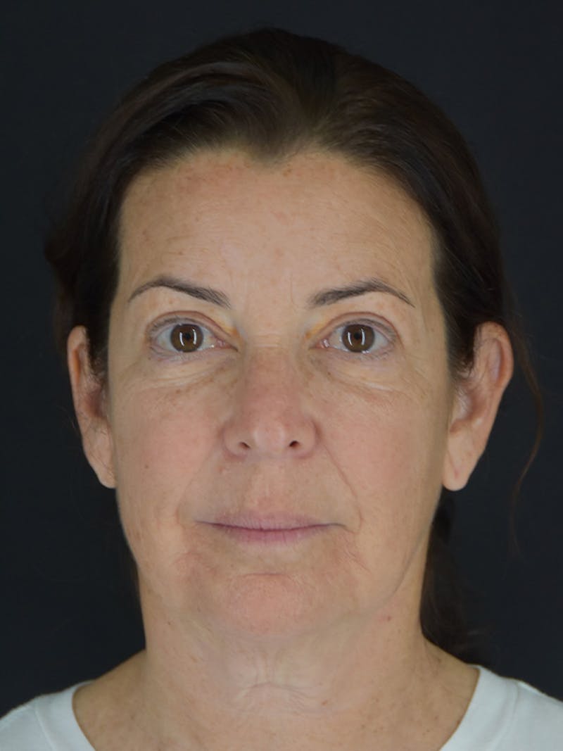 Fat Transfer Before & After Gallery - Patient 933449 - Image 1