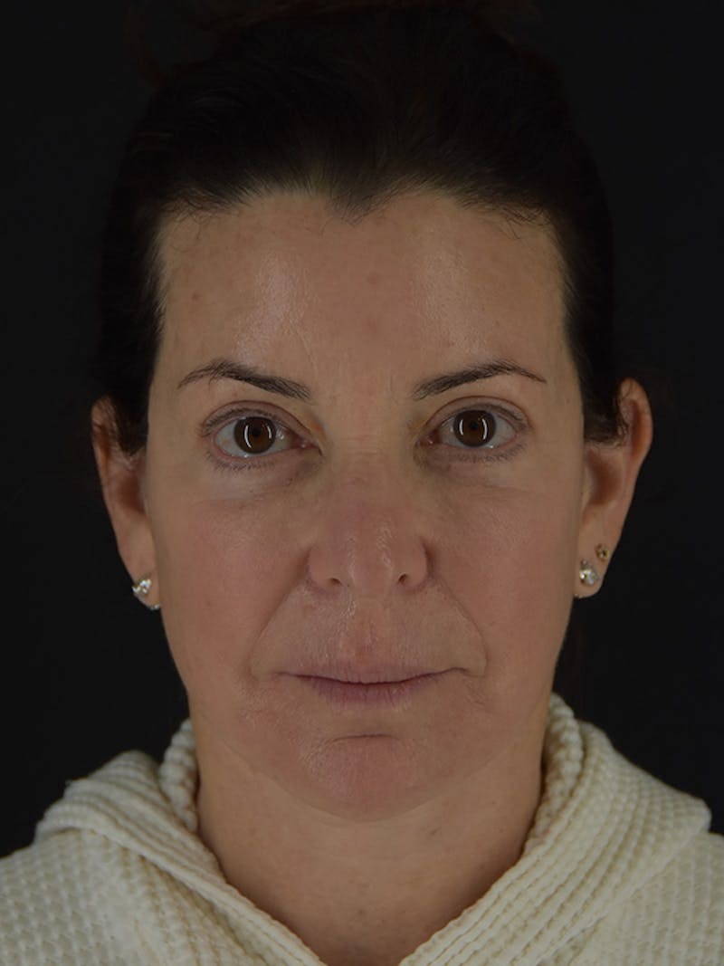 Fat Transfer Before & After Gallery - Patient 933449 - Image 2